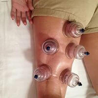 Cupping